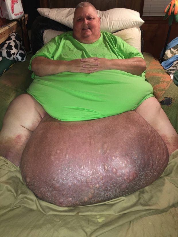 Roger Logan's tumor weighed nearly 140 pounds (Photo used with permission from Kitty Logan)