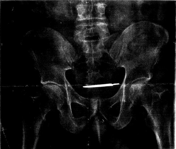 An X-ray image from Glenford Turner's lawsuit against the Veterans Administration, claiming a surgical tool was sewn into his abdomen after a 2013 surgery at a VA hospital in West Haven, Conn. (Image: U.S. District Court for the District of Connecticut)