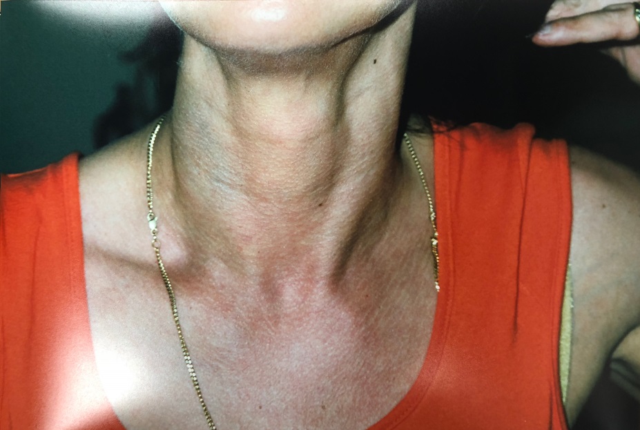 Dallas Garland's bruised neck the day after her alleged assault by Steve Sisolak on August 24, 2000. Courtesy Dallas Sisolak